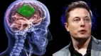Elon Musk Tanam Chip Di Otak Manusia. Ilmuwan Cemas Nasib Pasien Elon Musk yang Otaknya Ditanam Chip Neuralink