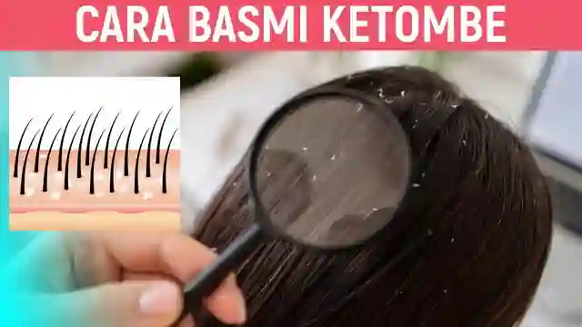 posjos.com — Basmi Ketombe Dengan Cara Alami Basmi Ketombe. Cara Menghilangkan Ketombe. Cara Alami Menghilangkan Ketombe